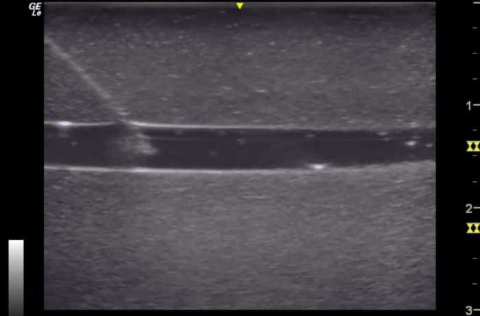 Hm4.0 Reusable 4 Vessel Ultrasound Phantom Training - Image 7