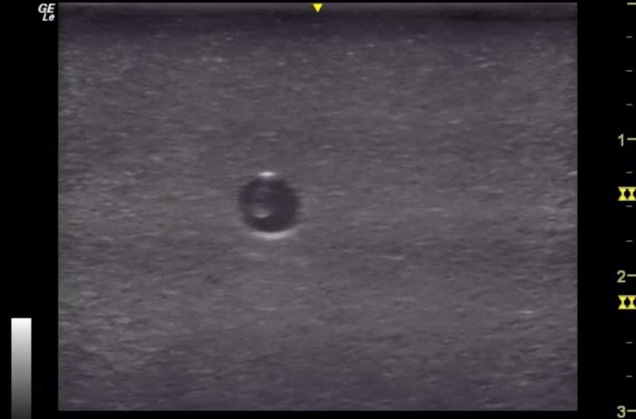 Hm2.0 Re-Moldable 2 Vessel Ultrasound Training Model - Image 8