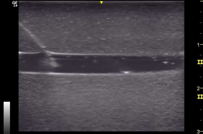 Hm2.0 Re-Moldable 2 Vessel Ultrasound Training Model - Image 6